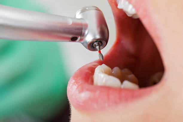 Best Emergency Tooth Extraction in Vincent, AL